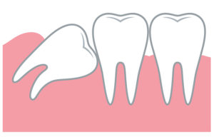 estrarre i denti del giudizio