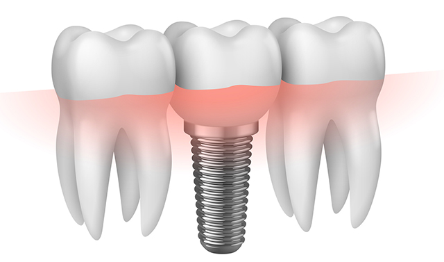 trattamento implantare