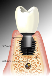 impianto_dentale_corto_bicon